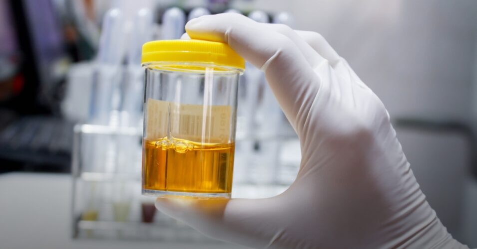 Oral Drug Tests vs Urine Tests: Which Is Best for Your Workplace?