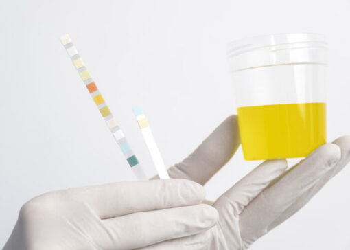 Gloved hand holding a urine sample cup