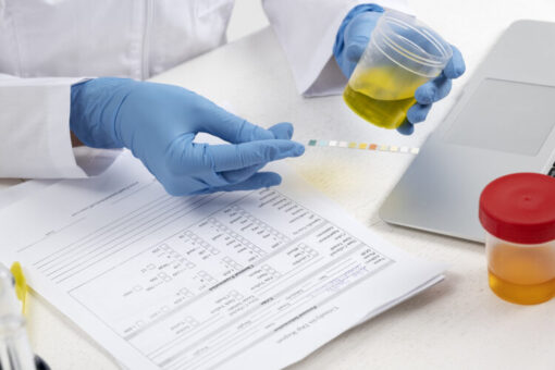 Urine sample specimen being analyzed for a multi-panel construction site drug test screening