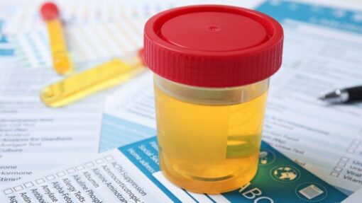 specimen collection container filled with urine for multi-panel drug screening